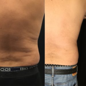 body contouring flanks before and after