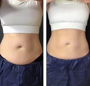 body sculpting love handles and abdomen before and after from the front