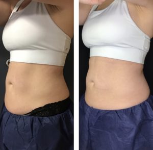 body sculpting love handles and abdomen before and after side view