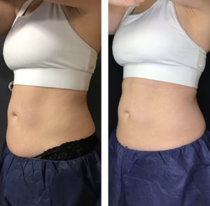 Body Contouring for Slidell, Madisonville and Hammond, LA and